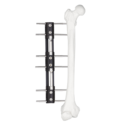 Bone Lengthening External Fixator - Type A