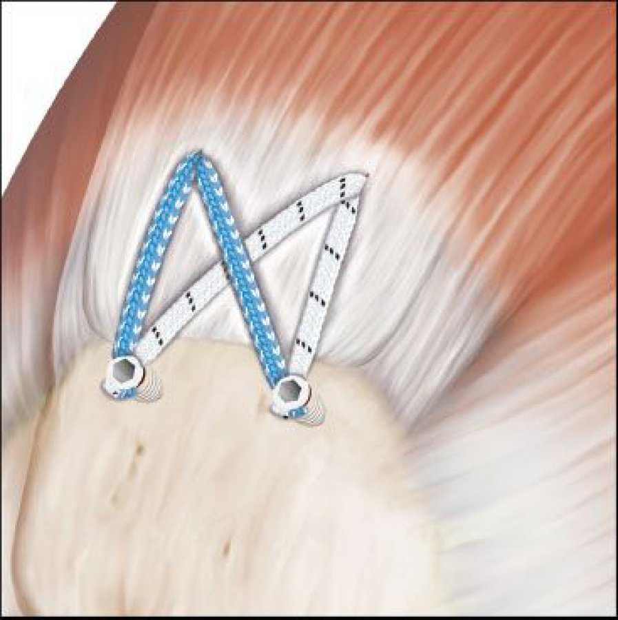Fiber Tape Suture