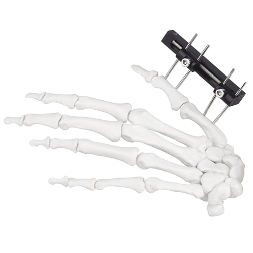 Mini Fragment External Fixator (Finger and Palm)