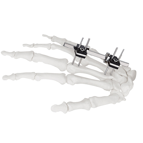Mini Fragment External Fixator (Finger and Palm)