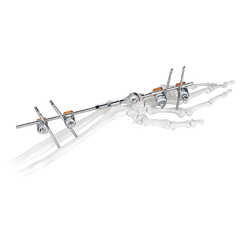 Wrist Joint External Fixator