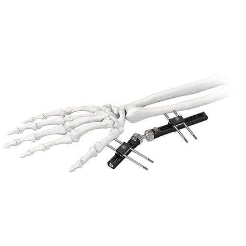 Wrist Joints External Fixator