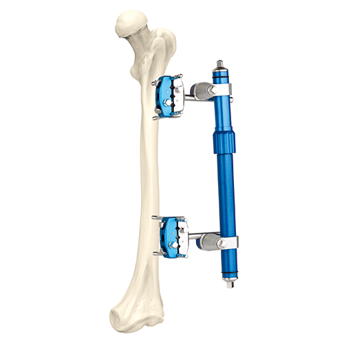 Femoral External Fixator