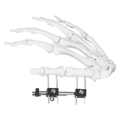 Mini Fragment External Fixator (Finger and Palm)
