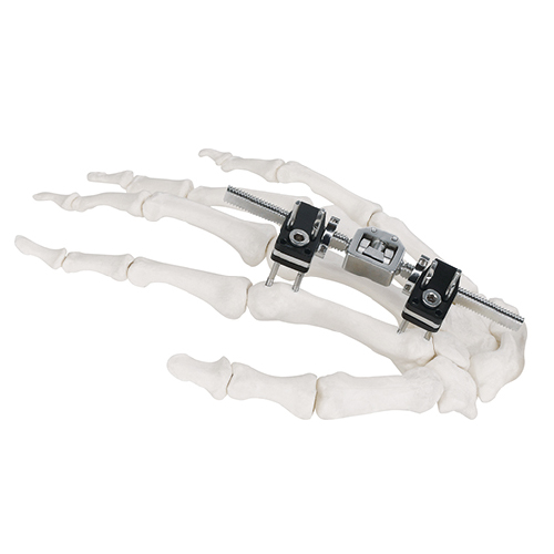 Mini Fragment External Fixator (Finger and Palm)