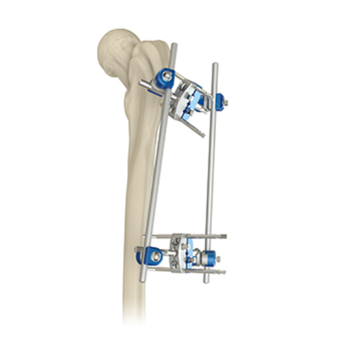 Proximal Femur External Fixator