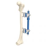Femoral External Fixator