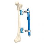 Femoral External Fixator