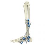 Ankle Joint External Fixator