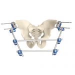 Pelvic External Fixator