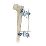 Proximal Femur External Fixator