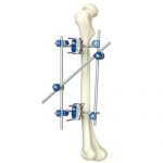 Tibia & Percone  External Fixator
