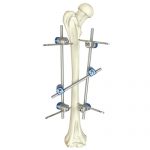 Femoral Shaft External Fixator