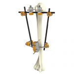 Humeral Shaft External Fixator