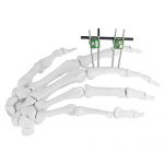 Finger & Palm External Fixator