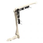 Knee Joint External Fixator