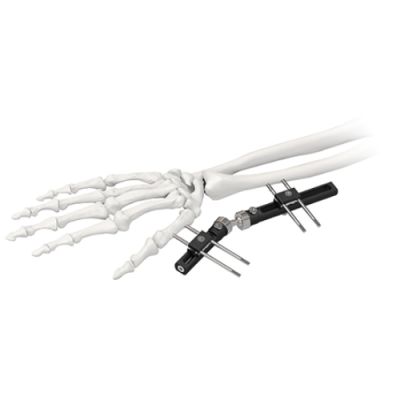Wrist Joints External Fixator