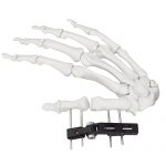 Mini Fragment External Fixator (Finger and Palm)