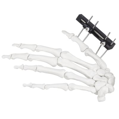 Mini Fragment External Fixator (Finger and Palm)