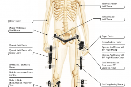 Double-level, proximal-to-distal bone transport using wire fixation. A